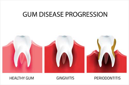 Gum Disease Progression Image