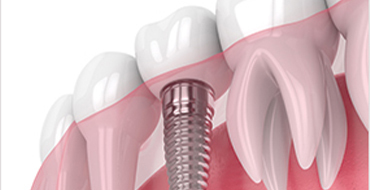 The Ultimate Guide To Dental Implants 