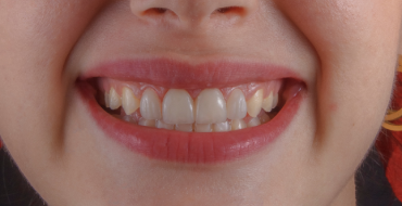 What Is Gingival Hyperplasia