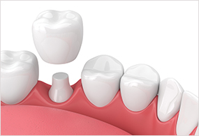 Crowns Bridges Dental Services