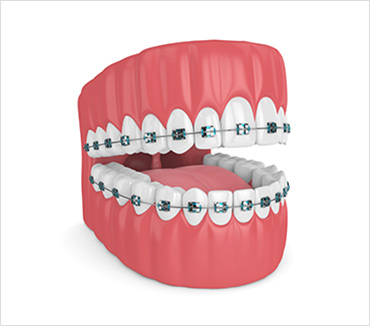 Dental Braces - Image