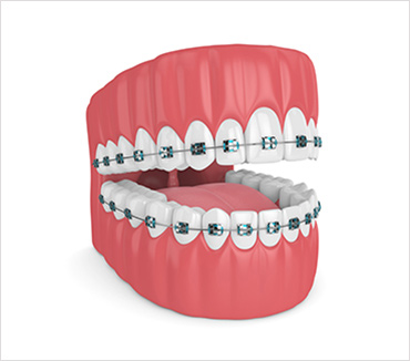 Affordable Braces Treatment, Orthodontics