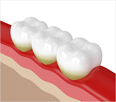 Gum Treatments Image