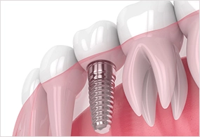 Implants Dental Services - Image