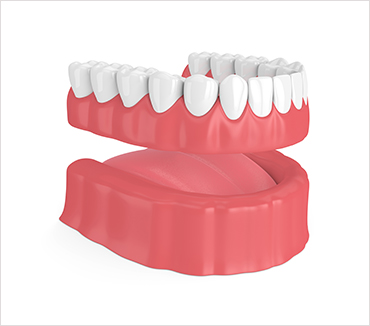 Partial Full Dentures - Image