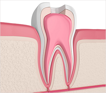 Dental Implants Inner Image