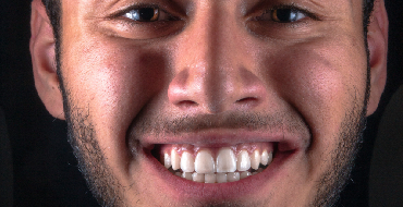 Understanding the Cost of Wisdom Teeth Removal