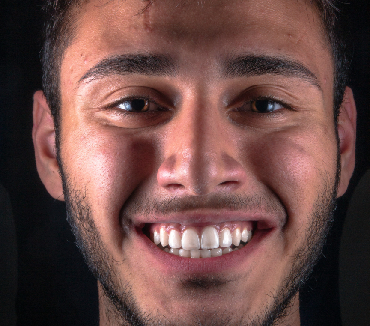 Wisdom Teeth Removal Cost