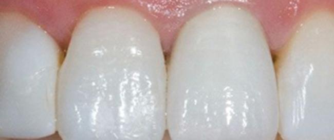 All Porcelain Crowns After