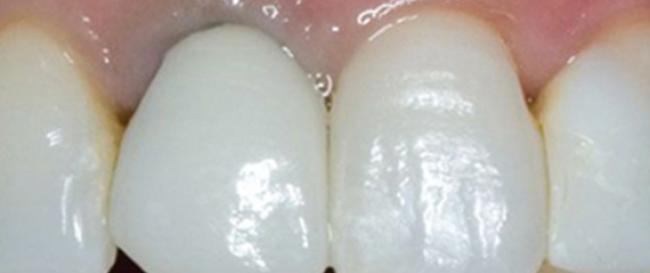 All Porcelain Crowns Before