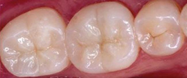 Tooth colored composite After