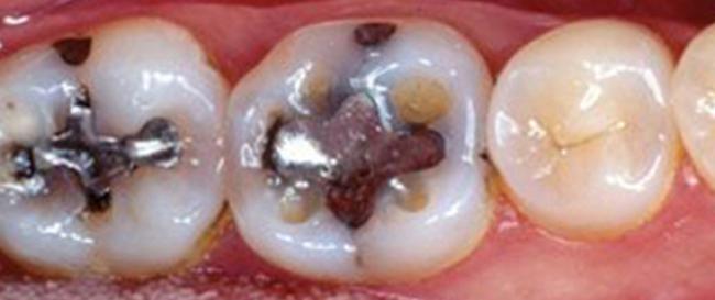 tooth-colored-composite-before
